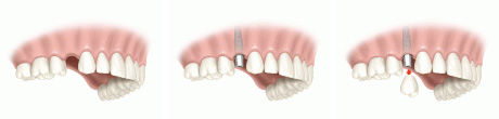 Implante para un solo diente