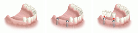 Implante para varios dientes